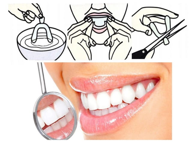 Snoring Brace 2 Pack- Clear - In plastic bag - Anti Snurk Beugel